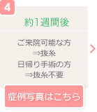 4-1週間後　ご来院可能な方→抜糸　日帰り手術の方→抜糸不要（症例写真はこちら）