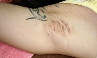 皮べん法による他院の治療症例写真