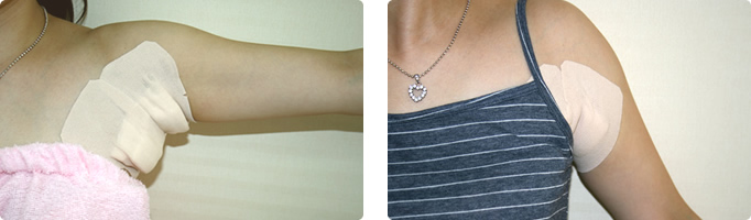 クワドラカット法のテープ固定