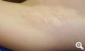 術後1年経過（右）