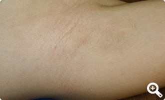 術後1年経過（左）