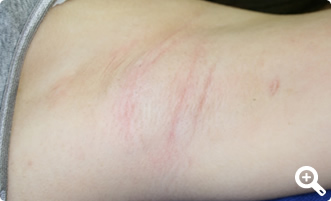 術後2年経過（左）