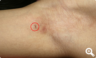 術後1ヶ月（右）