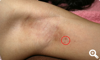 術後1ヶ月（左）