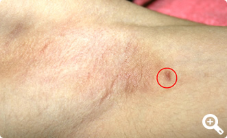 術後3ヶ月（左）