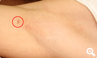 術後4ヶ月（右）